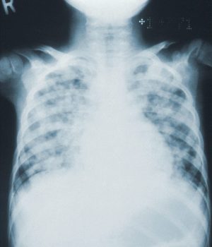 Computerthomographie einer Lunge